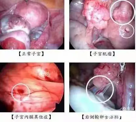 子宫肌瘤的形成与治疗